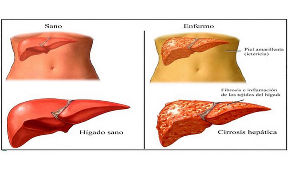 cirrosis del higado vs higado sano