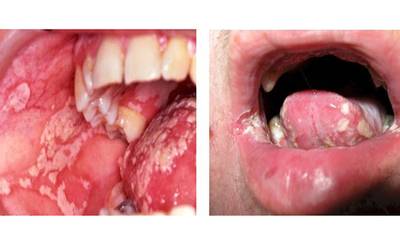 Candidiasis Oral O Algodoncillo Diario De Xalapa Noticias Locales Policiacas Sobre Mexico Veracruz Y El Mundo