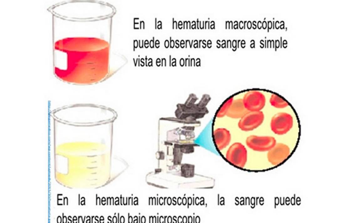 Hematuria Sangre En La Orina Generalidades 